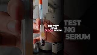 CRP test  creaction protein test shorts shortsfeed shortsvideo [upl. by Atnovart182]