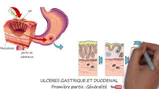 ULCÈRES GASTRIQUE ET DUODÉNAL  Première partie Généralité [upl. by Jamaal]