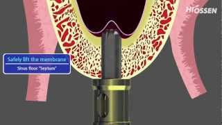 OSSTEM  HIOSSEN CASKit Crestal Approach Sinus Kit [upl. by Salene]