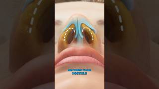 Septoplasty 3D Animation [upl. by Namyaw]