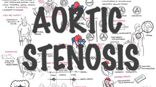 Aortic Stenosis  Overview signs and symptoms pathophysiology treatment [upl. by Gabrielson]