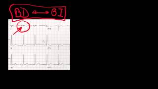 CURSO DE ELECTROCARDIOGRAFIA 21  ERRORES Y ARTEFACTOS DE REGISTRO [upl. by Assen579]