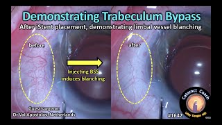 CataractCoach 1642 demonstrating trabeculum bypass with iStent MIGS glaucoma device [upl. by Marla]