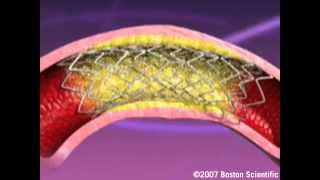 Heartistry Stent Implant Animation [upl. by Albarran]