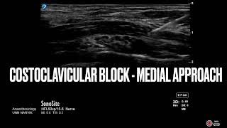 Costoclavicular block  medial approach  Regional anesthesia ultrasound regionalanesthesia [upl. by Lletram911]