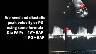 How to estimate pulmonary artery pressure on Echo [upl. by Dorree]