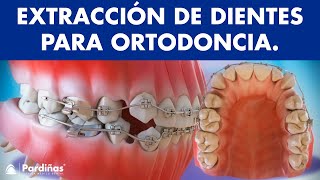 EXTRAER DIENTES para una ORTODONCIA  ¿Te han dicho de QUITAR los PREMOLARES ¿Es necesario [upl. by Ssur]