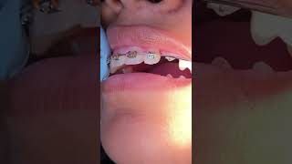 Impacted Canine Braces Treatment  13 Months of Orthodontic Traction  Tooth Time Family Dentistry [upl. by Cirillo680]