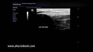 Jumpers knee  MSK ultrasound [upl. by Vic]