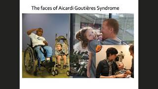 Aicardi Goutieres Syndrome AGS and other Calcifying Leukodystrophies [upl. by Libre]