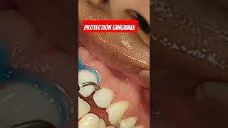 Protection gingivale pour le blanchiment des dents [upl. by Etneciv816]