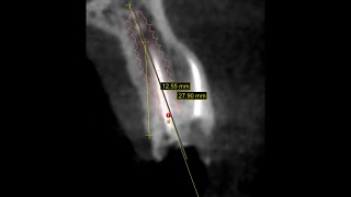 Atraumatic extraction  Immediate implant placement  upper first premolar [upl. by Ronyar499]