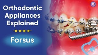 Orthodontic Appliances Explained  Forsus [upl. by Naanac996]