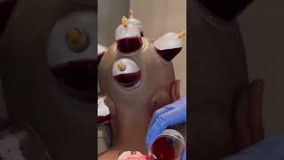 Cupping therapy  Hijama on the head  Wet cupping shorts [upl. by Karim]