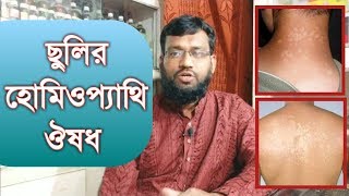 ছুলির হোমিওপ্যাথি ও বায়োকেমিক ঔষধ  Tinea versicolor homeopathy treatment in bangla [upl. by Kurtzman919]