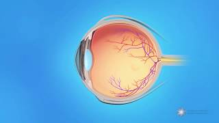 What is central retinal vein occlusion CRVO [upl. by Salocin]