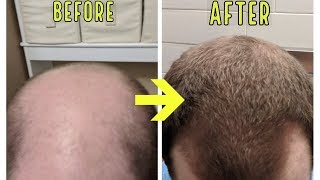 CRAZY MICRONEEDLING RESULTS TO STOP BALDING AND HAIR LOSS [upl. by Alin]