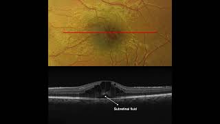 Cystoid Macular Edema in Pars Planitis OCT Interpretation [upl. by Esilana]