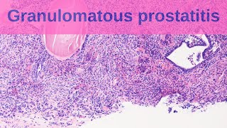 Granulomatous Prostatitis  Pathology mini tutorial [upl. by Vladimar]