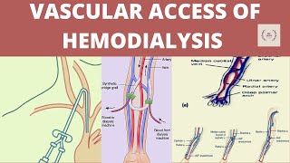 Vascular access of hemodialysis Vascular access Vascular access of dialysis AV fistula AV graft [upl. by Kcinomod68]