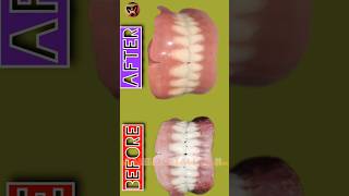 Dental Lab Work  BeforeampAfter  Polished Denture  Tamil Dental Lab  vitalvideo completedenture [upl. by Bone]