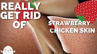 HOW TO GET RID OF STRAWBERRY LEGS  No More Bumpy Skin Keratosis Pilaris kp or Chicken Skin [upl. by Onileba145]