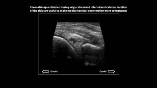 Meniscal degeneration not tear on dynamic knee ultrasound [upl. by Shifra]