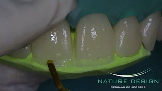 Fechamento de Diastema e Aumentos Incisais [upl. by Lehsreh613]