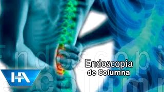 Endoscopia de Columna [upl. by Eelorac58]