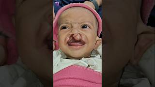 Wide Bilateral Cleft Lip Repair  Before  After  Dr Parit Ladani [upl. by Seyer]