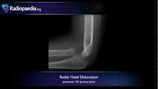 Radial head dislocation  radiology video tutorial xray [upl. by Vyner]