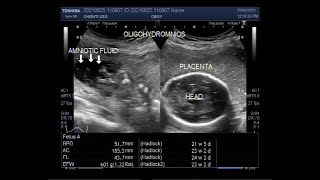 Oligohydramnios with loss of fetal movements and Pregnancy of about 23 weeks [upl. by Saunderson]