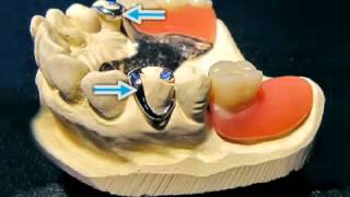 Ankerzahn bei Teilprothesen [upl. by Nauj]