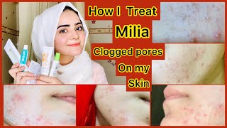 How To Treat Milia Clogged Pores Permanently At Home  Self Experienced  Dietitian Aqsa [upl. by Kifar]