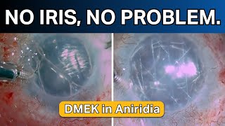 No iris no problem DMEK in aniridia [upl. by Animor]