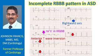 Incomplete RBBB pattern in atrial septal defect [upl. by Nanreit]