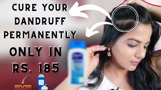 DANDRUFF  HOW TO GET RID OF DANDRUFF PERMANENTLY IN Rs 185 [upl. by Kile]