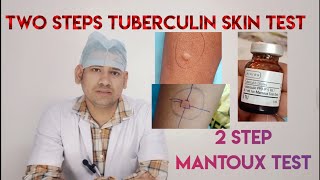 two step TUBERCULIN skin testtwo steps mantoux test mantoux test PPD SENSTIVITY TEST [upl. by Eerbua595]