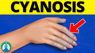 What is Cyanosis EXPLAINED [upl. by Ayotak146]