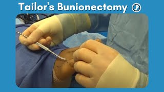 Tailors Bunionectomy performed by Dr Paul Steinke [upl. by Alisun]