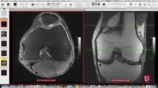 Systematic Interpretation of Knee MRI How I do it [upl. by Nnylimaj]