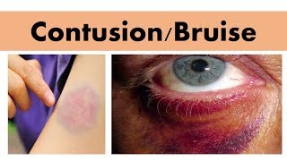 Blunt force impact injury CONTUSIONBRUISE [upl. by Eslek]