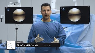 Dialing in the Tension With the FiberStitch™ 15 Implant [upl. by Annunciata]