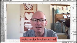 EKGQuickie Hochlateraler Myokardinfarkt [upl. by Freeman]