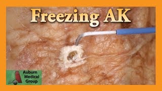 Freezing Hand Actinic Keratosis with Liquid Nitrogen  Auburn Medical Group [upl. by Arikehs861]