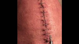 How to Remove Surgical Staples from Total Knee Replacement [upl. by Otrebla]