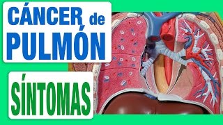 Cáncer de Pulmón  Síntomas [upl. by Odnalra]