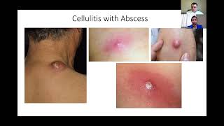 Diagnosis and Treatment of Cellulitis [upl. by Marva]