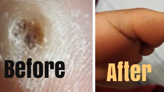 Plantar Wart treatment  Update Part 2 [upl. by Wieren]