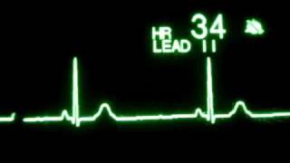 Sinus Bradycardia [upl. by Nylsoj437]